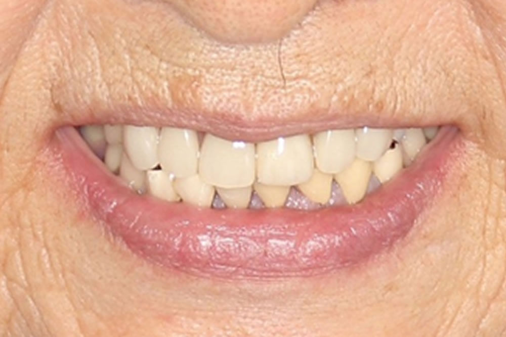 治療後 口元の見え方