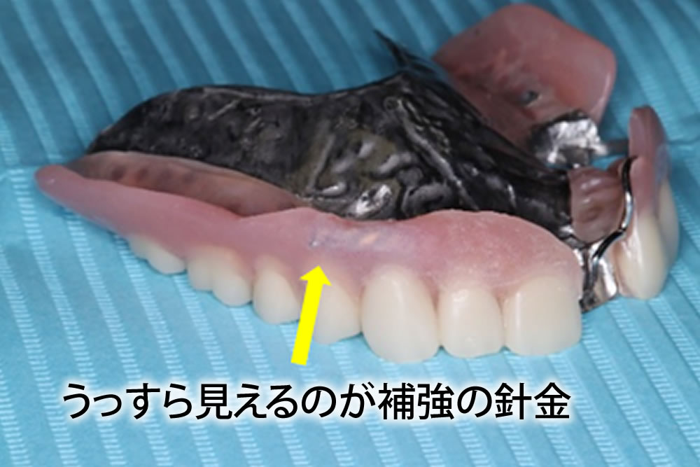 義歯の修理