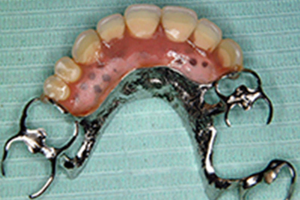 入れ歯治療例