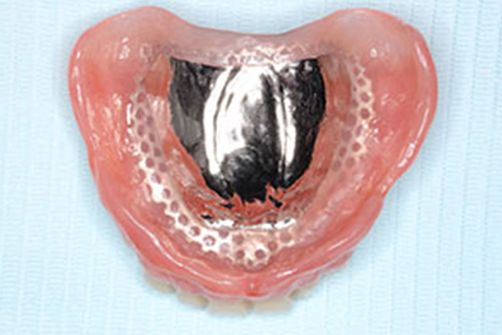 金属 床 による 総 義歯 の 提供